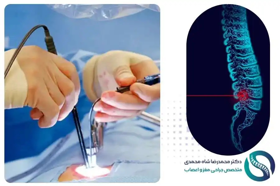 جراحی لیزر دیسک کمر - دکتر شاه محمدی