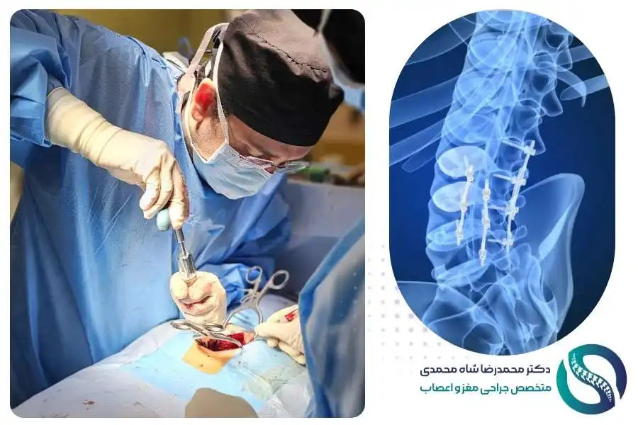 جراحی باز دیسک کمر - دکتر شاه محمدی