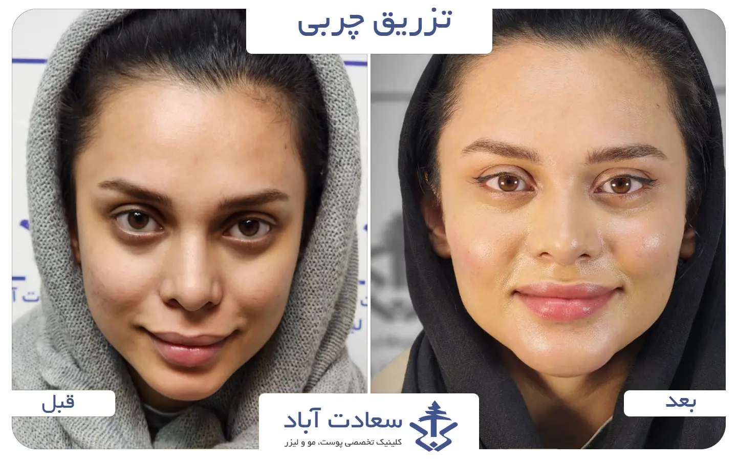 تصاویر قبل و بعد تزریق چربی به صورت