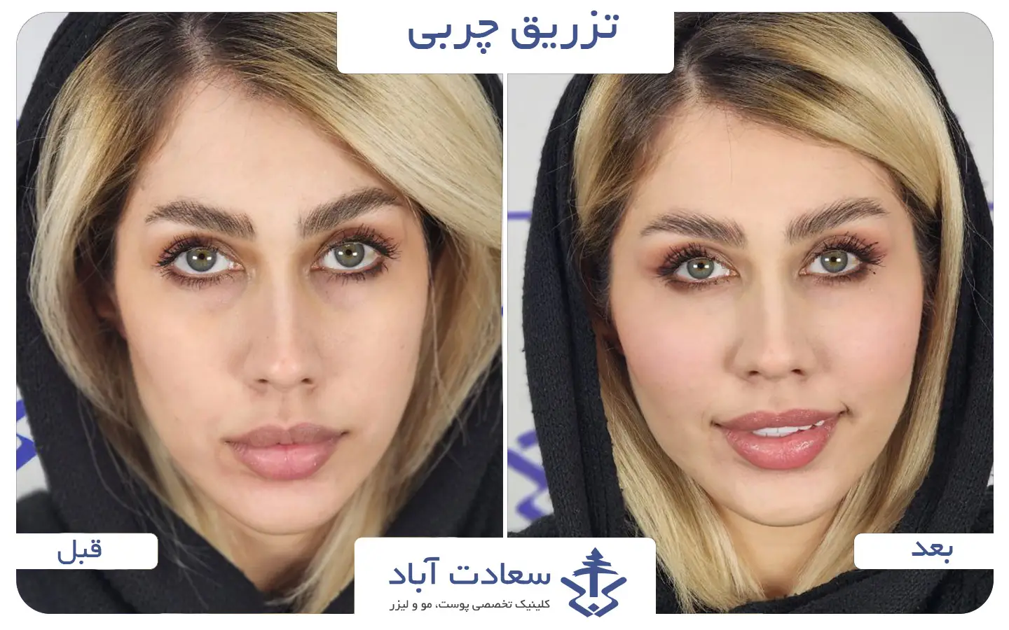 تصاویر قبل و بعد تزریق چربی به صورت