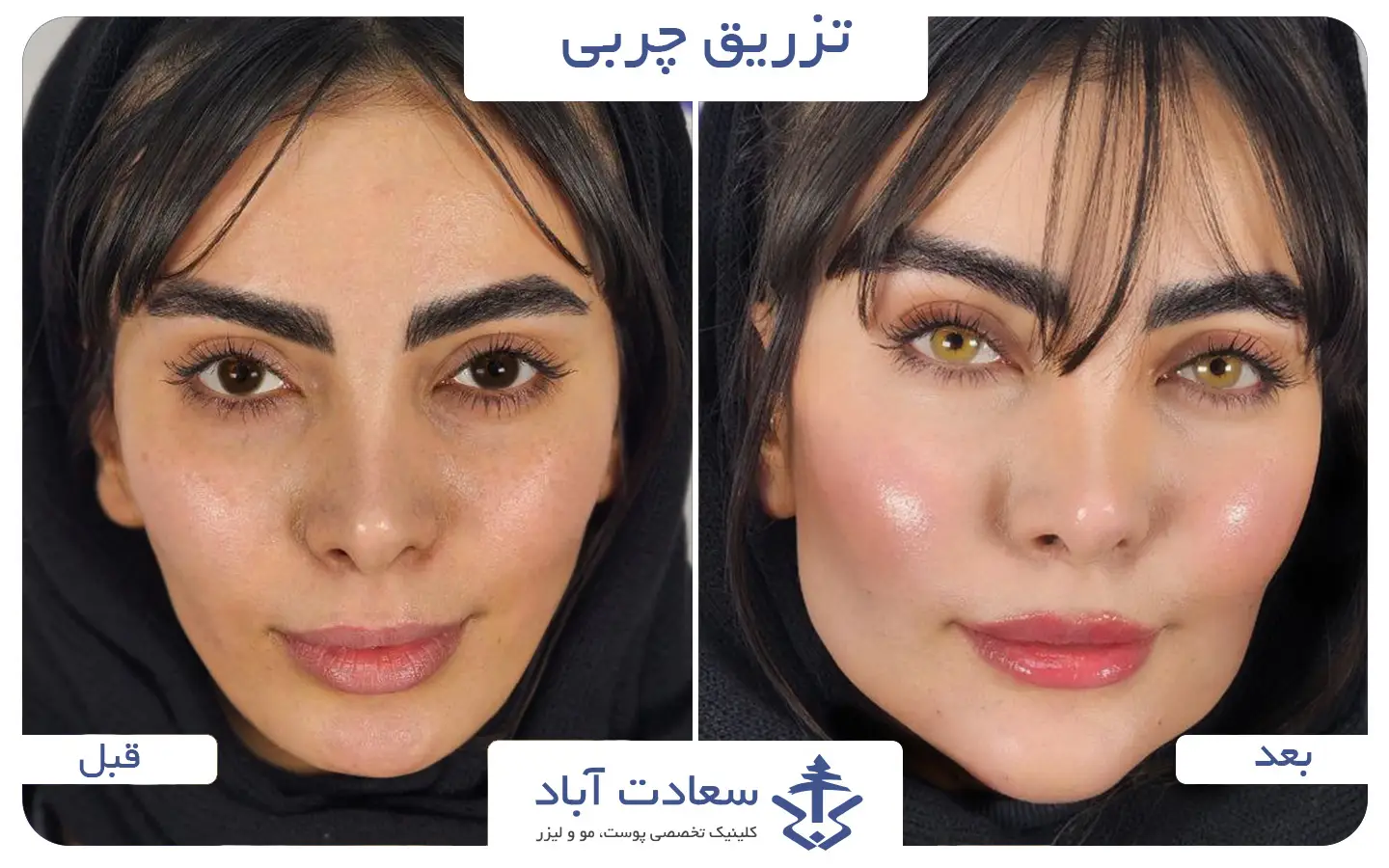تصاویر قبل و بعد تزریق چربی به صورت