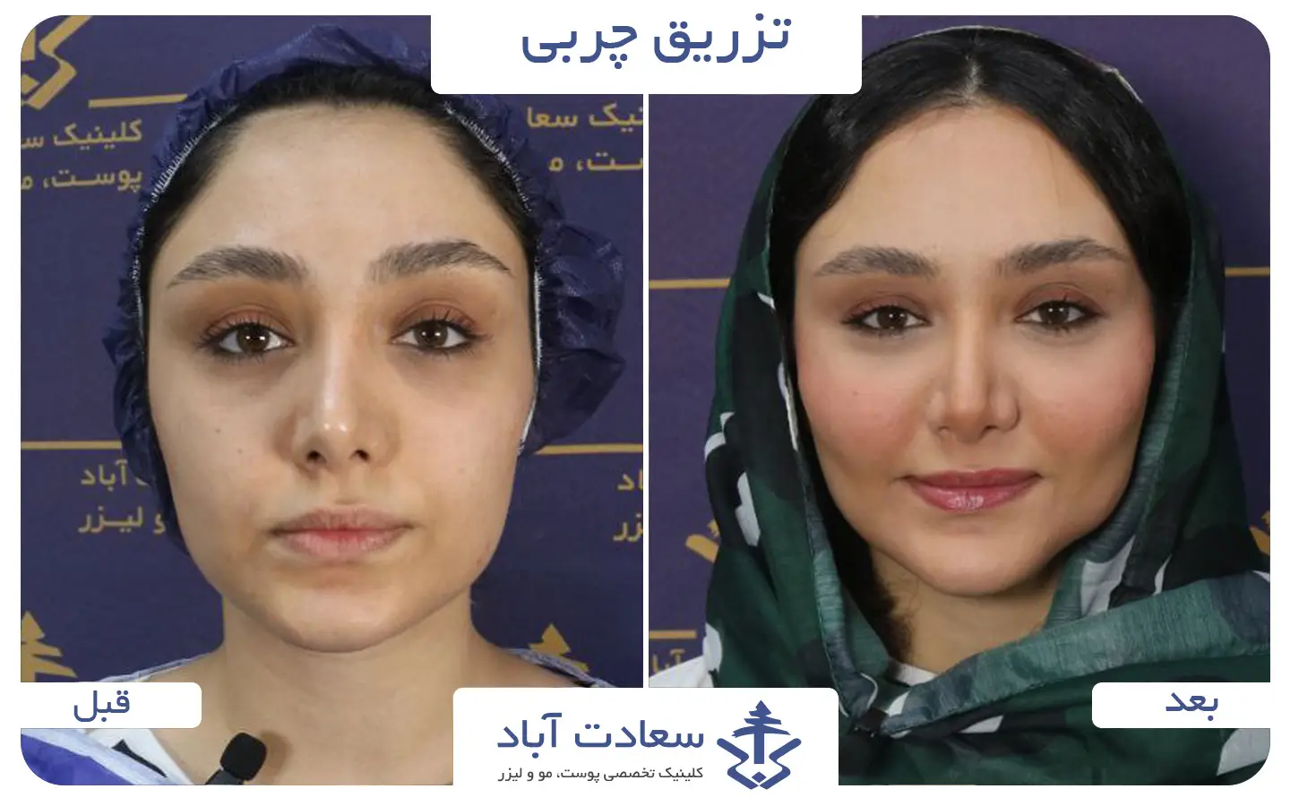 تصاویر قبل و بعد تزریق چربی به صورت
