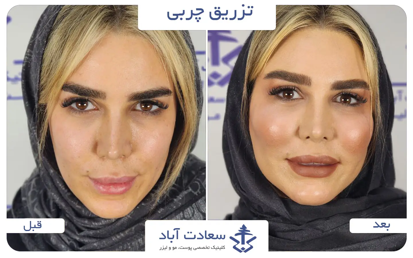 تصاویر قبل و بعد تزریق چربی به صورت