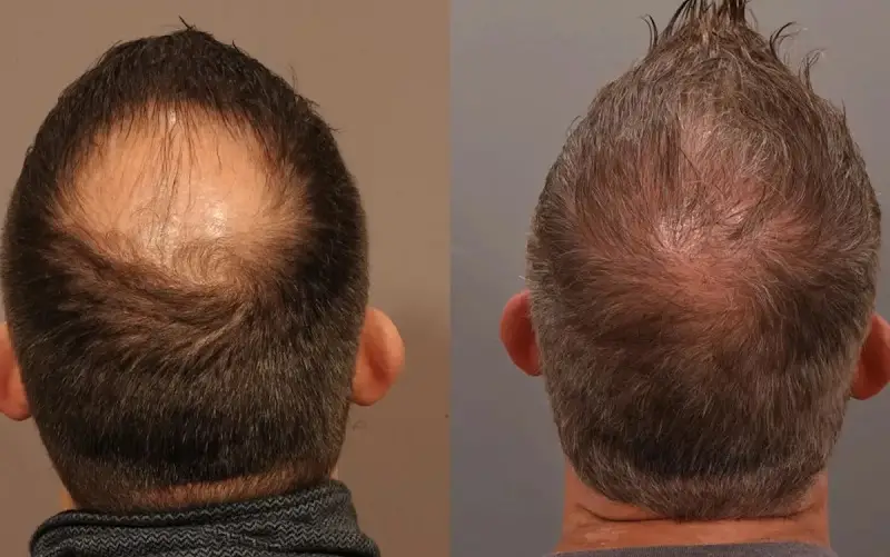 کلینیک کاشت مو در اصفهان