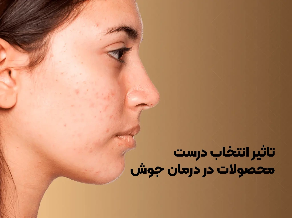 انتخاب صحیح محصولات برای درمان جوش