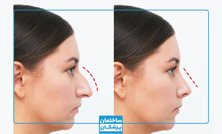 جراحی زیبایی بینی
