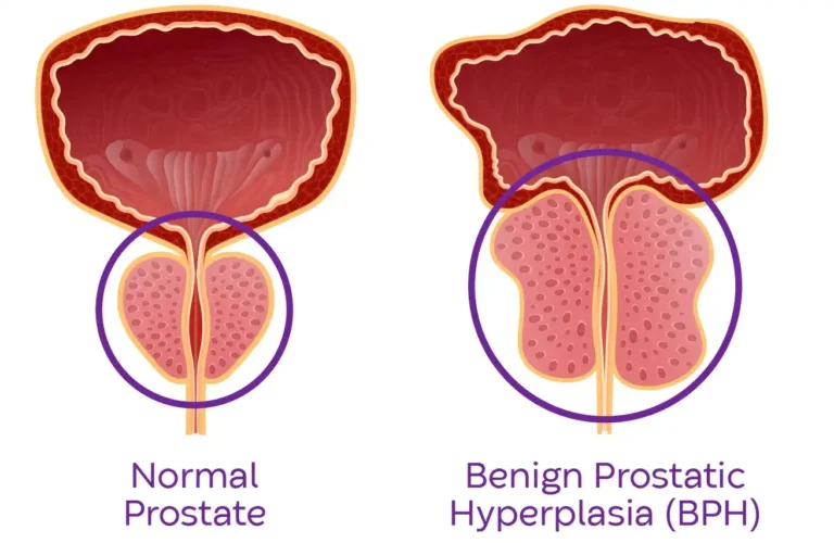 بزرگی خوش‌خیم پروستات (BPH)