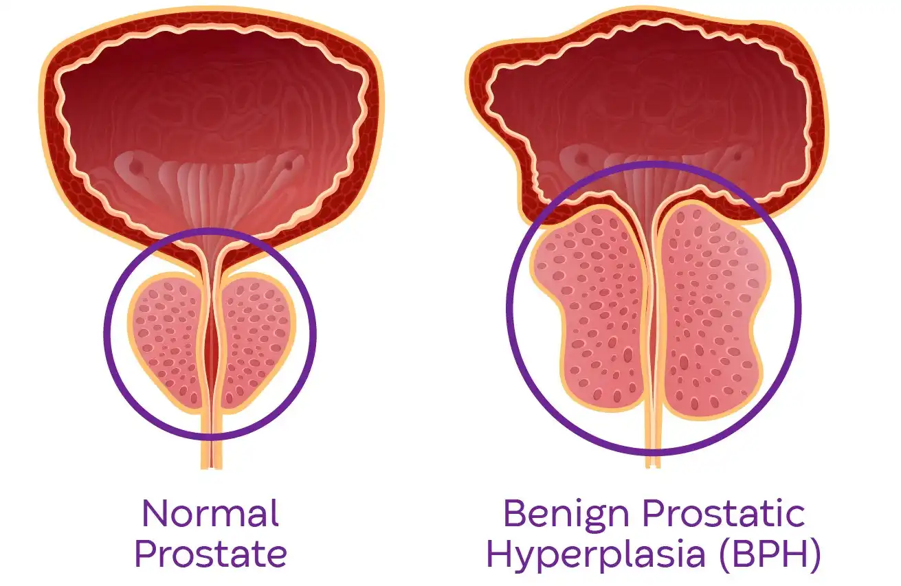 بزرگی خوش‌خیم پروستات (BPH)
