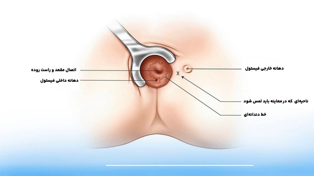 تصویر شماتیک فیستول مقعدی در ناحیه رکتوم و مقعد