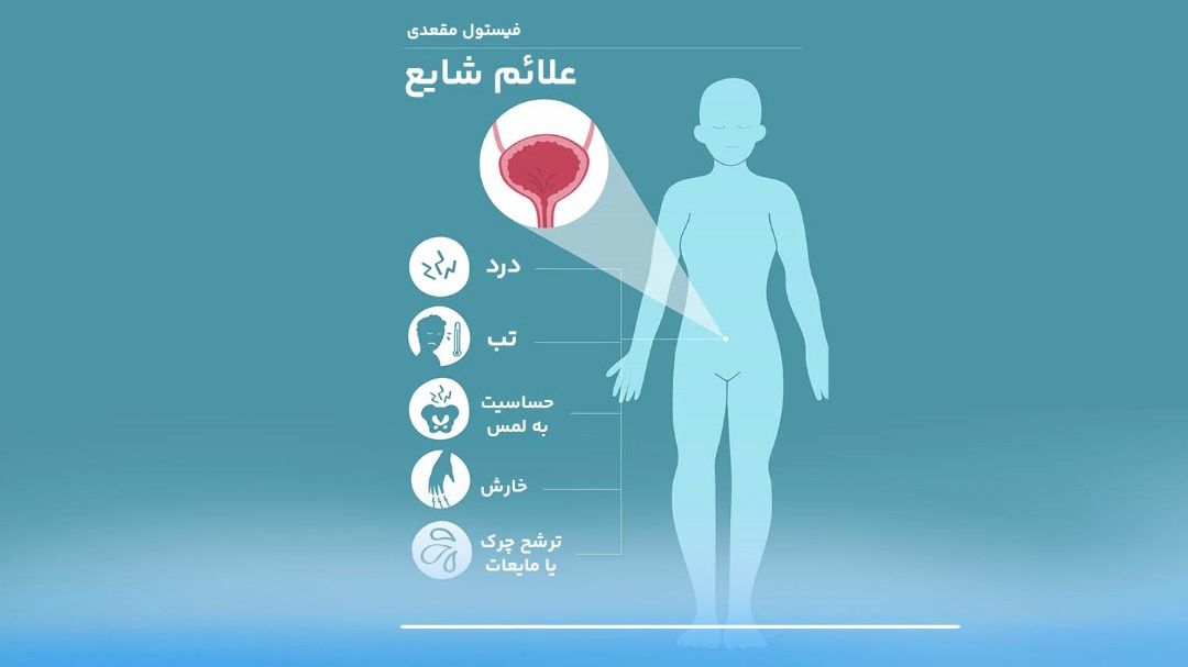 علائم شایع فیستول مقعدی شامل درد، ترشح چرکی، التهاب و خارش