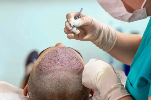 ویژگی‌ های یک آموزشگاه معتبر کاشت مو در تهران