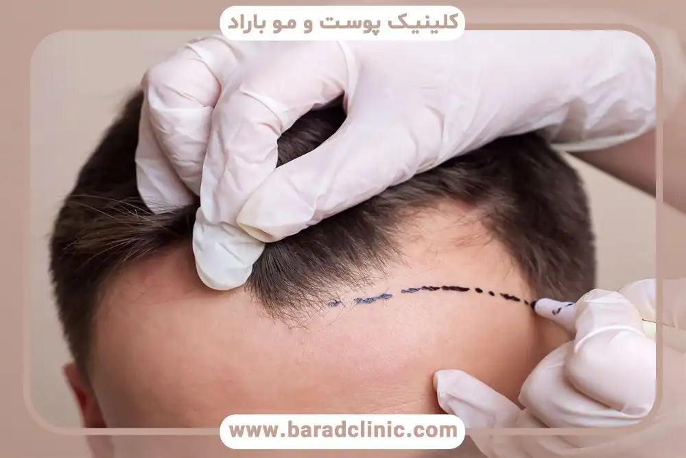 کاشت مو طبیعی