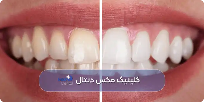 انواع کامپوزیت دندان در چیتگر تهران
