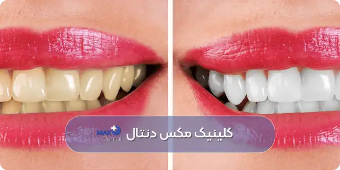 راهنمای انتخاب نوع کامپوزیت دندان