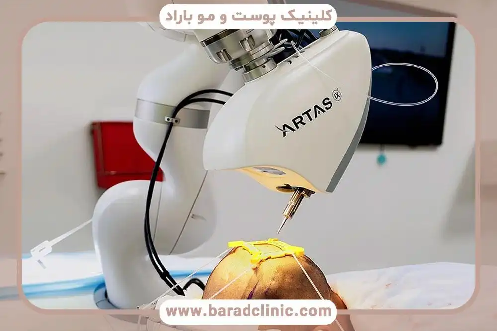 کاشت مو طبیعی