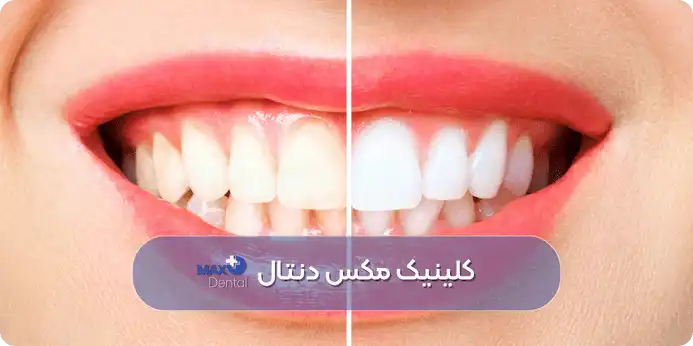 هزینه کامپوزیت دندان در چیتگر
