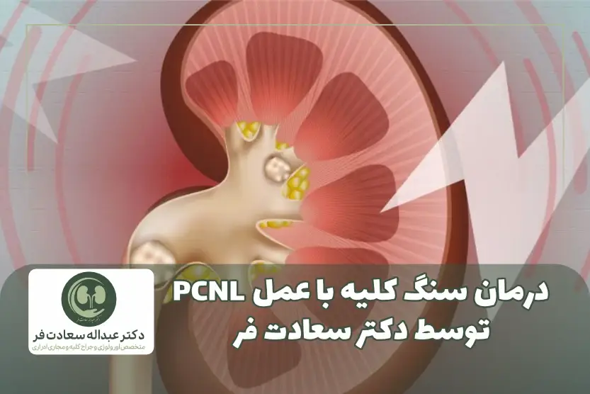 درمان سنگ کلیه با عمل PCNL توسط دکتر سعادت فر