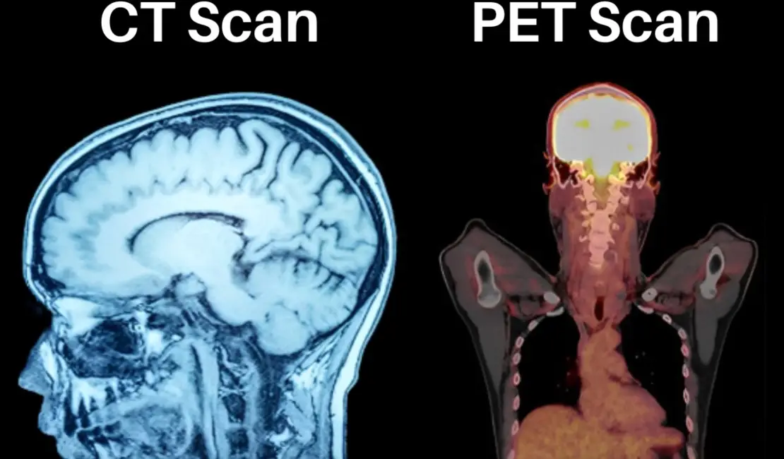 پتاسکن PET Scan
