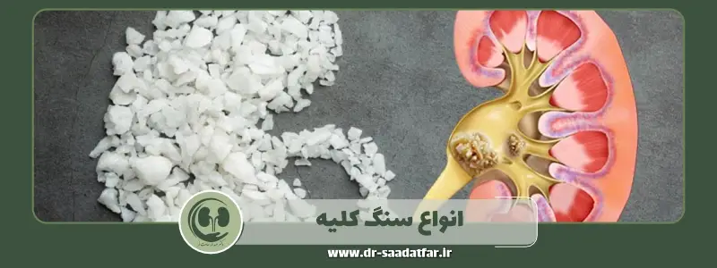 انواع سنگ کلیه