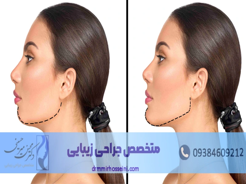 لیپوماتیک غبغب