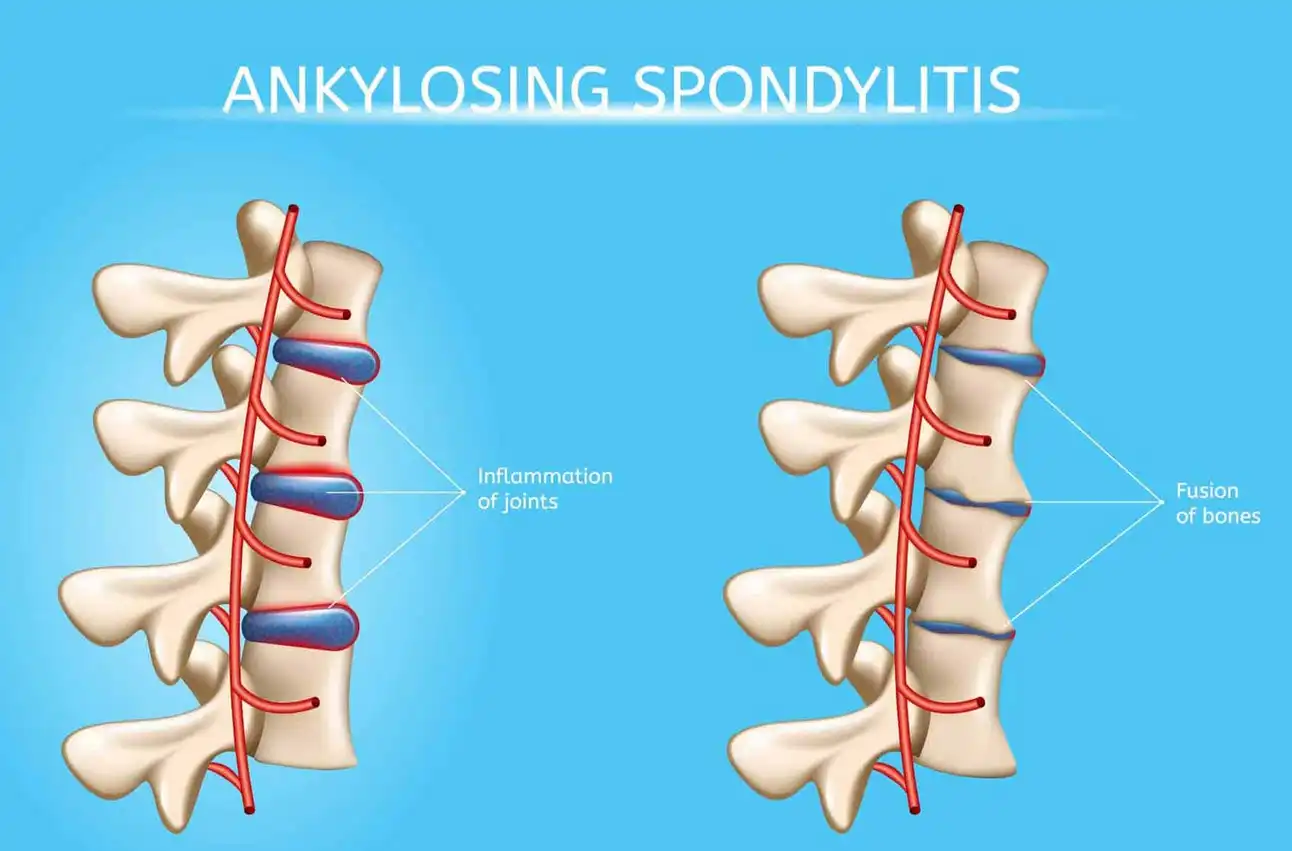 اسپوندیلیت آنکیلوزان