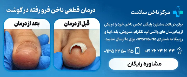 درمان رفتن ناخن در گوشت پا