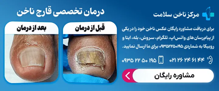 درمان قارچ ناخن پا