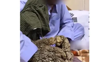 مرد درختی ایرانی (شهروند ۳۵ ساله اهل شهرستان خاش در استان سیستان و بلوچستان)