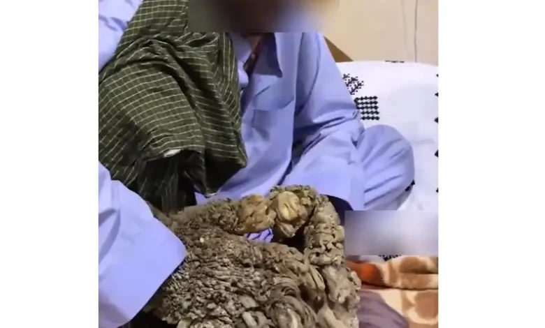 مرد درختی ایرانی (شهروند ۳۵ ساله اهل شهرستان خاش در استان سیستان و بلوچستان)