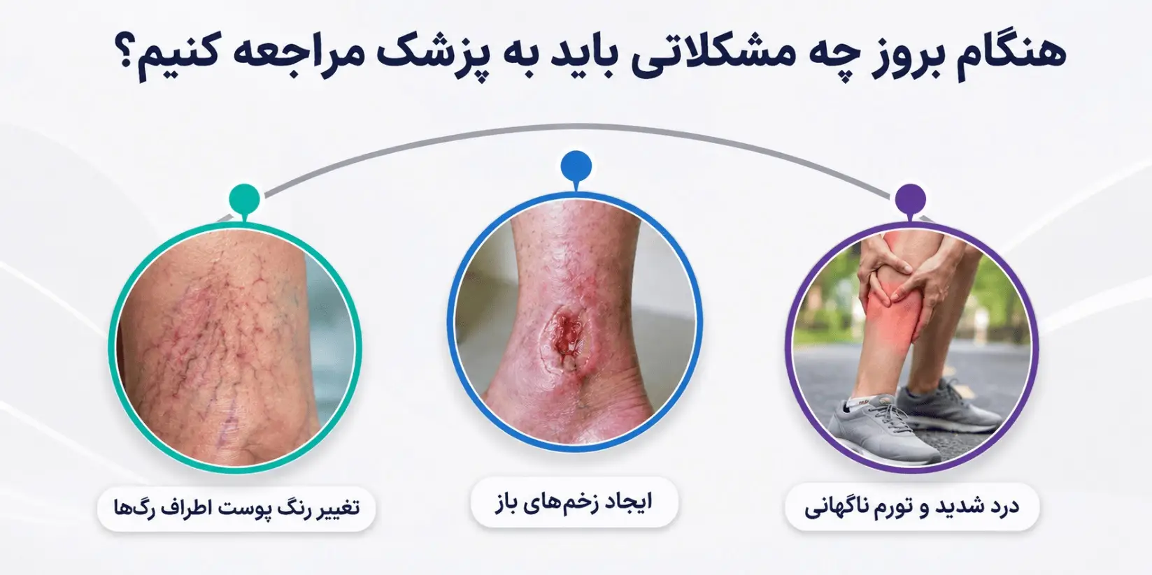 آیا پیاده روی برای واریس خوب است؟
